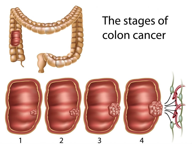تشخيص سرطان القولون